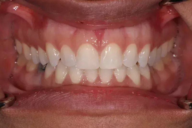 gum treatment before and after 2