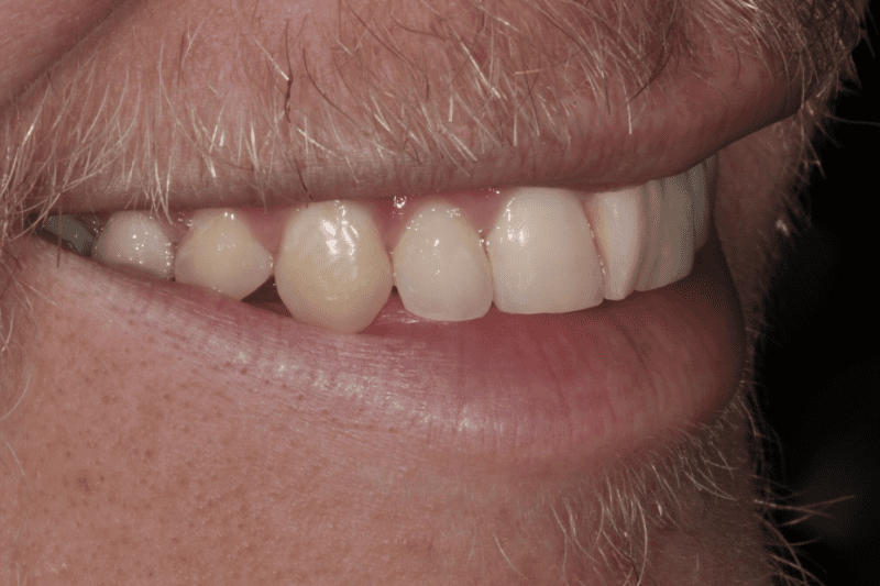 natural teeth before veneers natural-teeth-before-veneers