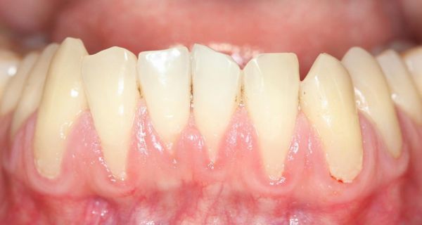 receding gums treatment