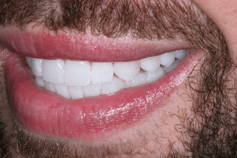 after natural look porcelain veneers after natural look porcelain veneers by best cosmetic dentist dr aleem