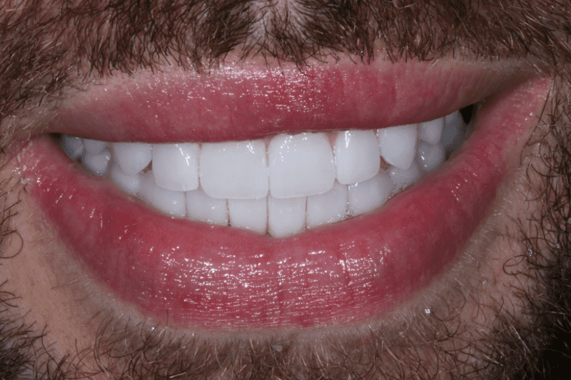after smile transformation with non damaging veneers after smile transformation with non damaging veneers