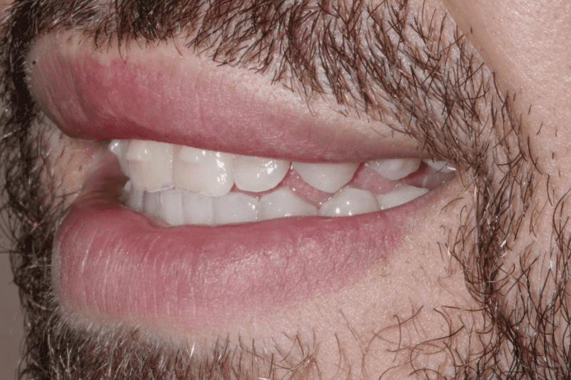 before no prep veneers before no prep veneers