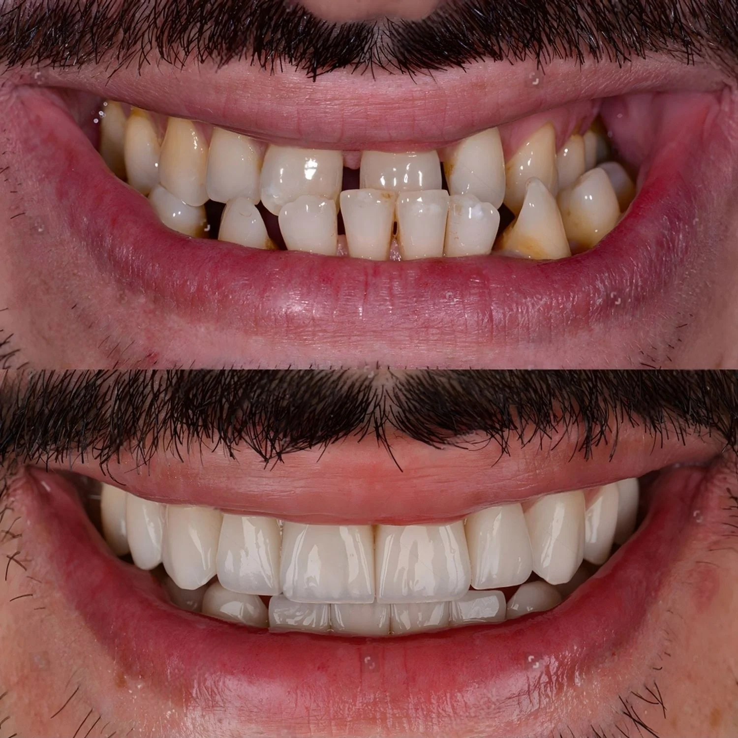 before and after all on 4 dental implants