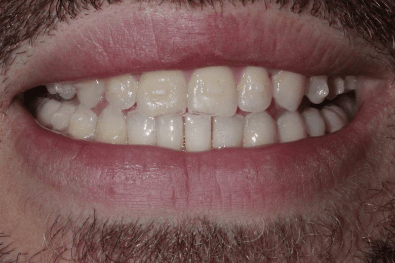 before porcelain veneers before porcelain veneers