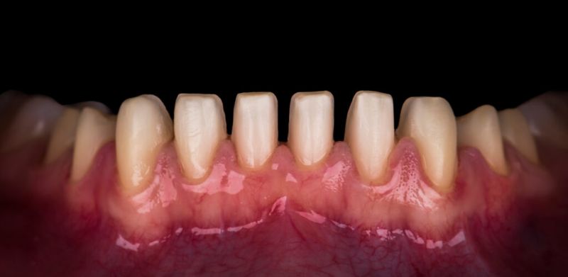 turkey teeth shaved enamel