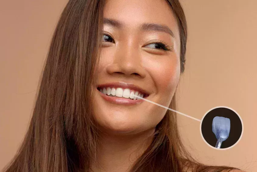 best-dental-veneers-london