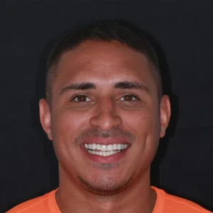 cosmetic-bonding-patient-case-2