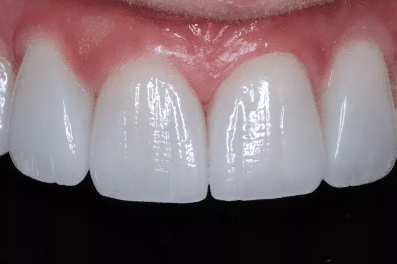 58C90287-22D6-46DF-A464-C5C3CD571F59 Zero damage porcelain veneers by Dr Aleem