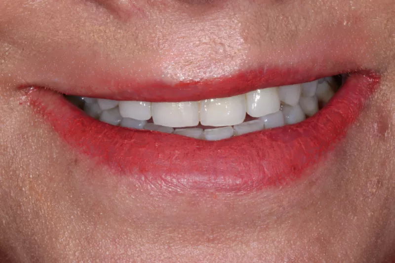 BEFORE NO SHAVE VENEERS