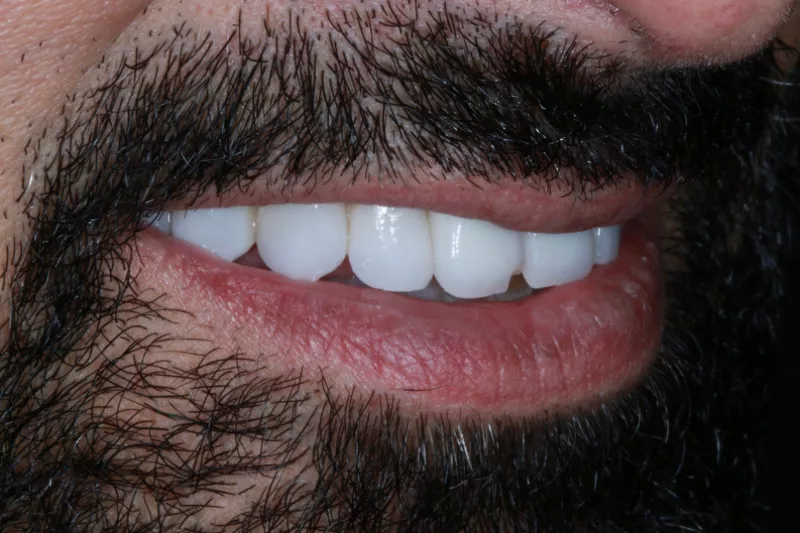 old veneers with solid colour no translucency