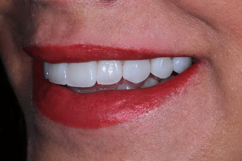 AFTER NO SHAVE NO PREP VENEERS NATURAL BRIGHTER SMILE WITH TKC VENEERS IN LONDON