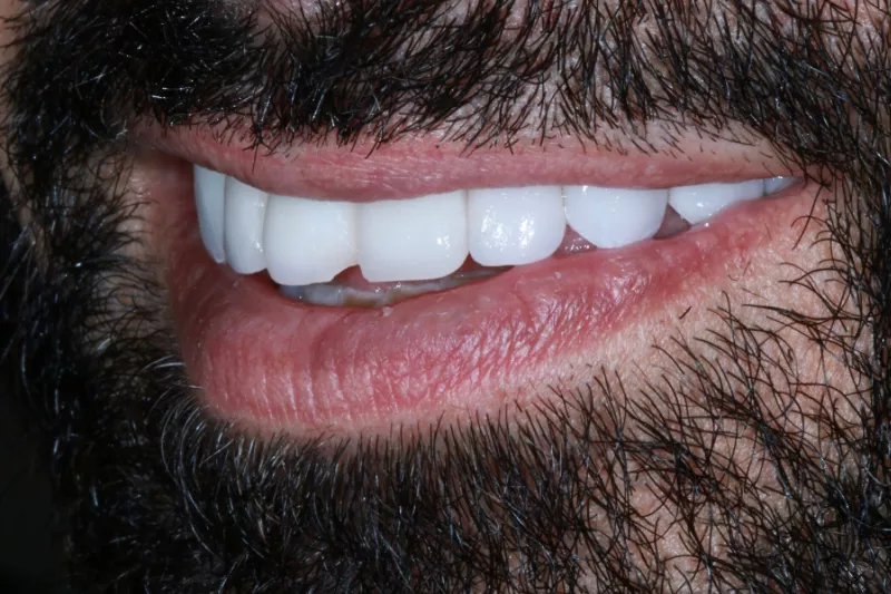 old veneers with solid colour no translucency