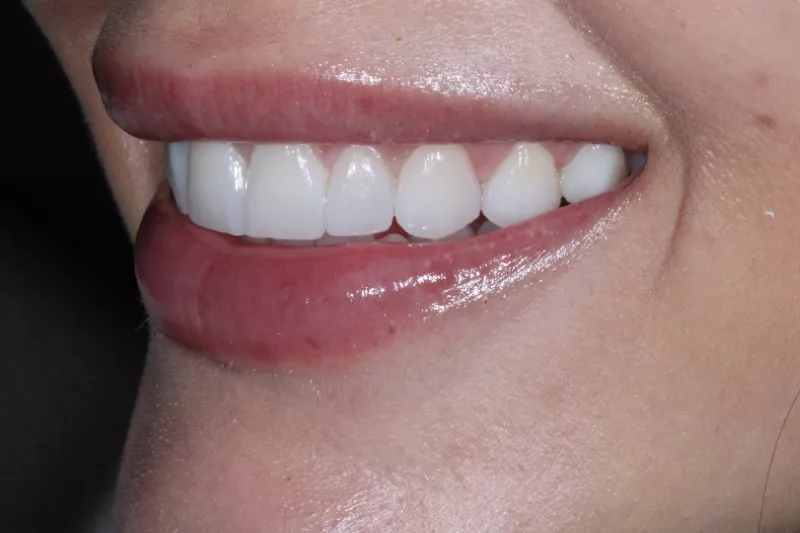 NO SHAVE NO DAMAGE NO PREP PORCELAIN VENEERS BEST NATURAL RESULTS IN LONDON