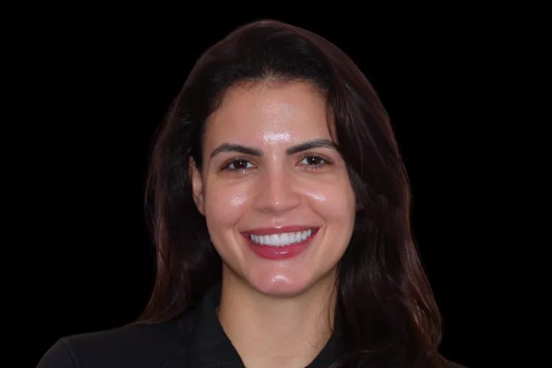 AFTER NO SHAVE VENEERS IN LONDON