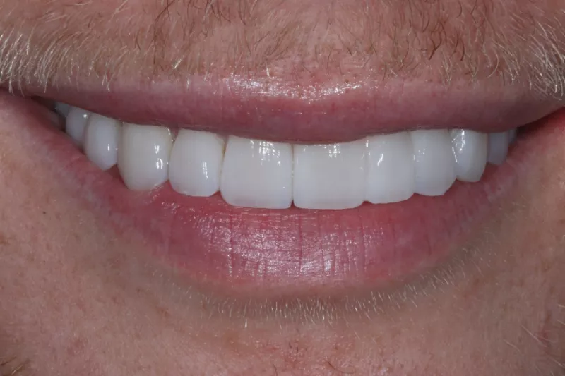 After no shave veneers
