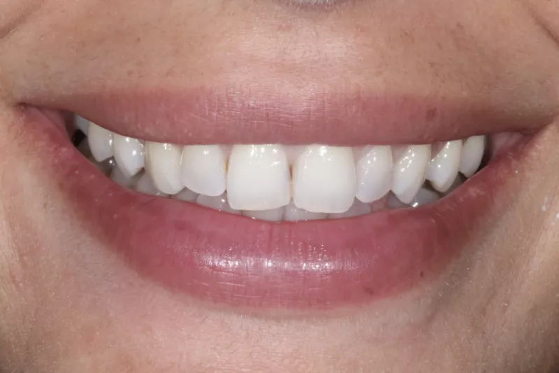 UNEVEN SMILE BEFORE NO PREP VENEERS