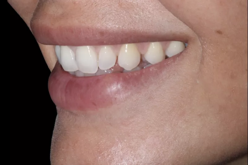 SPACING UNEVEN TEETH CLOSE GAPS WITH PORCELAIN VENEERS