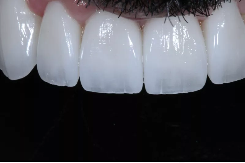 results with no damage veneers translucency shade and texture Zero damage porcelain veneers by Dr Aleem