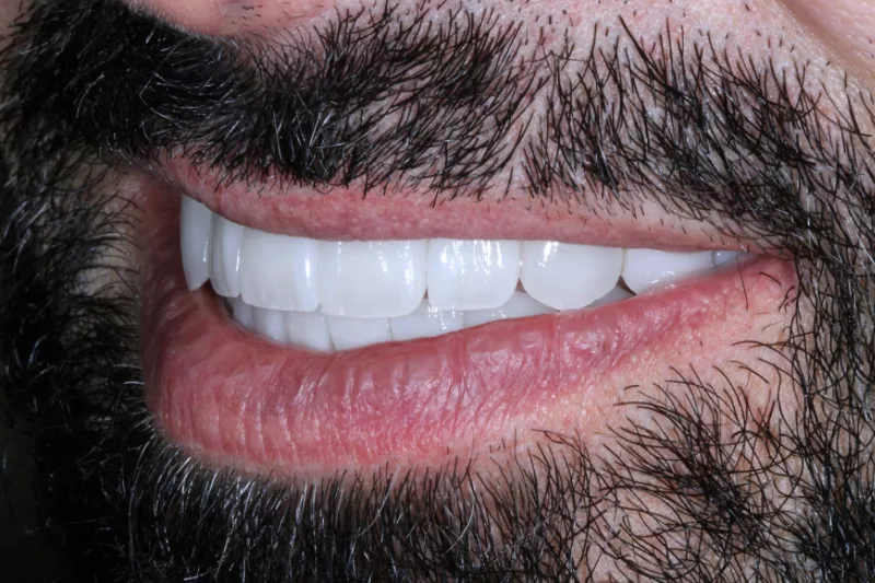 replaced old veneers with ultra thin natural looking veneers in london