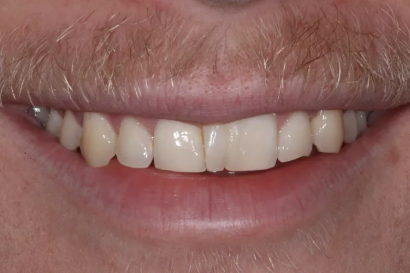 NATURAL TEETH BEFORE NO PREP VENEERS