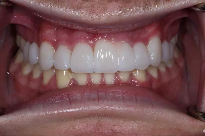 after non cutting London veneers