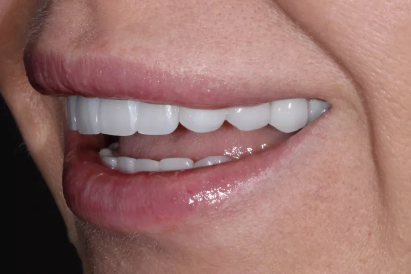 after no prep no shave veneers by dr aleem london kensington and knightsbridge