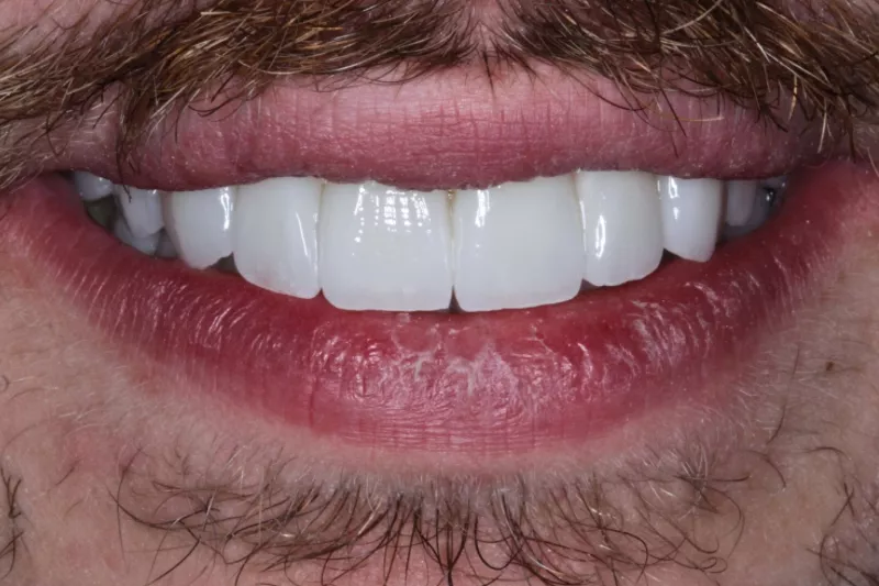 after no prep veneers in Knightsbridge and Kensington London