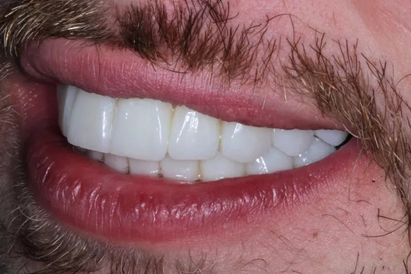 after no shave no non damaging veneers by Dr Aleem