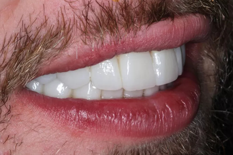 after no shave veneers in london