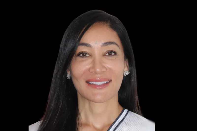 No shave veneers by Dr Aleem