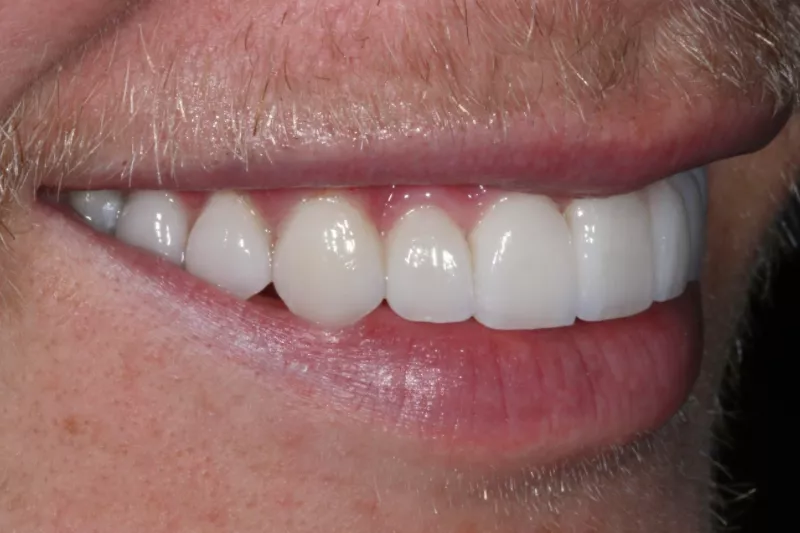 after no prep veneers by Dr Aleem