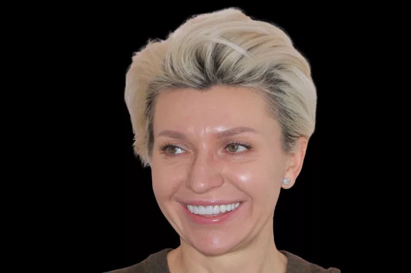 after tkc veneers by dr aleem no shave veneers in London