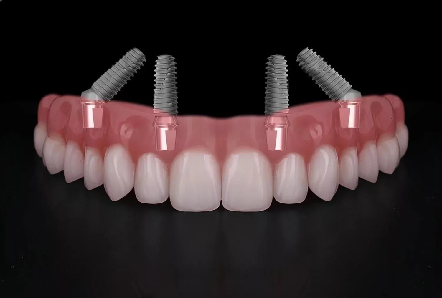 all on 4 dental implants uk price
