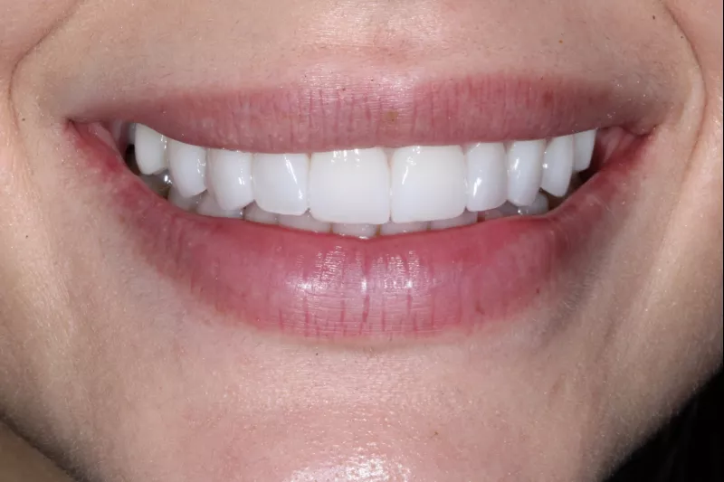 FULL UPPER SMILE DESIGN WITH TKC NO SHAVE VENEERS IN KNIGHTSBRIDGE LONDON