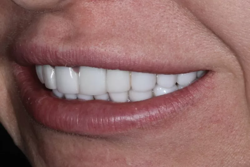 opaque veneers replaced with no shave veneers in London