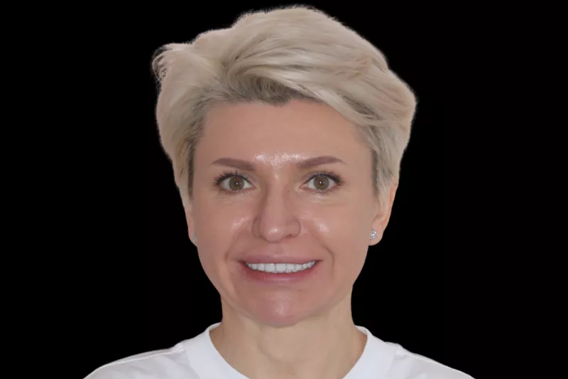 blocky old veneers to replace with thin and natural no shave veneers