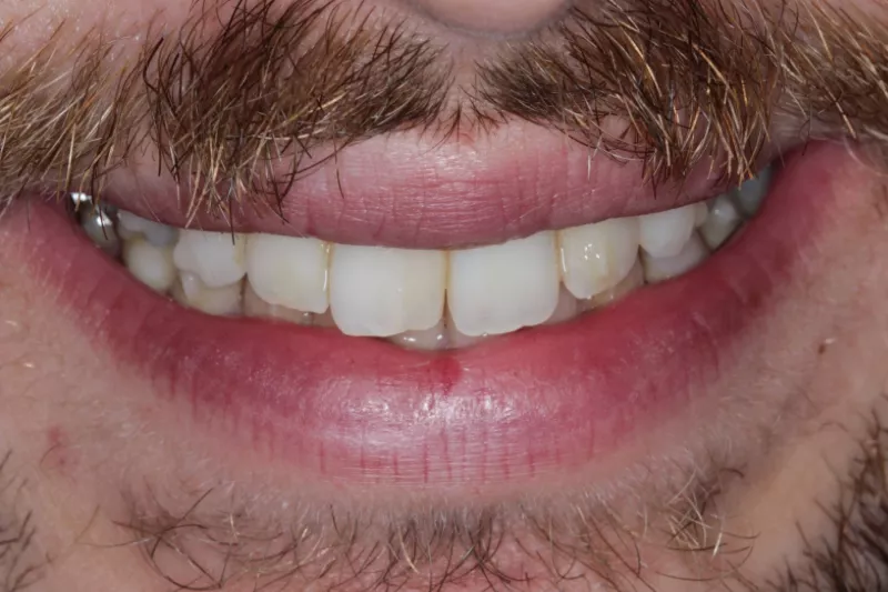 before veneers discoloured and misshapen teeth