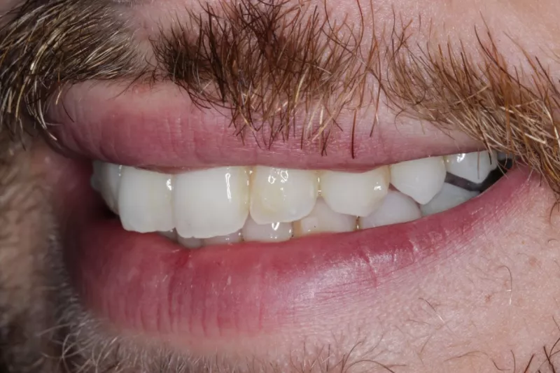 before veneers misshaped and discoloured teeth