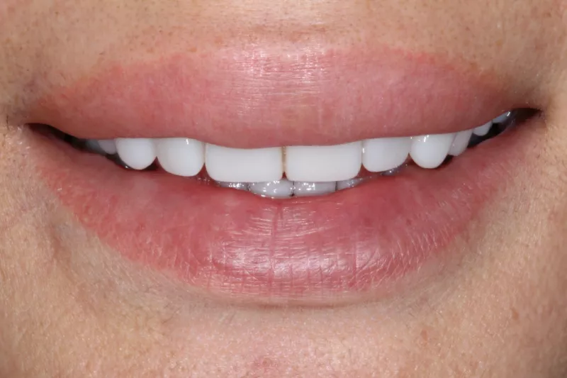 narrow smile before no prep veneers
