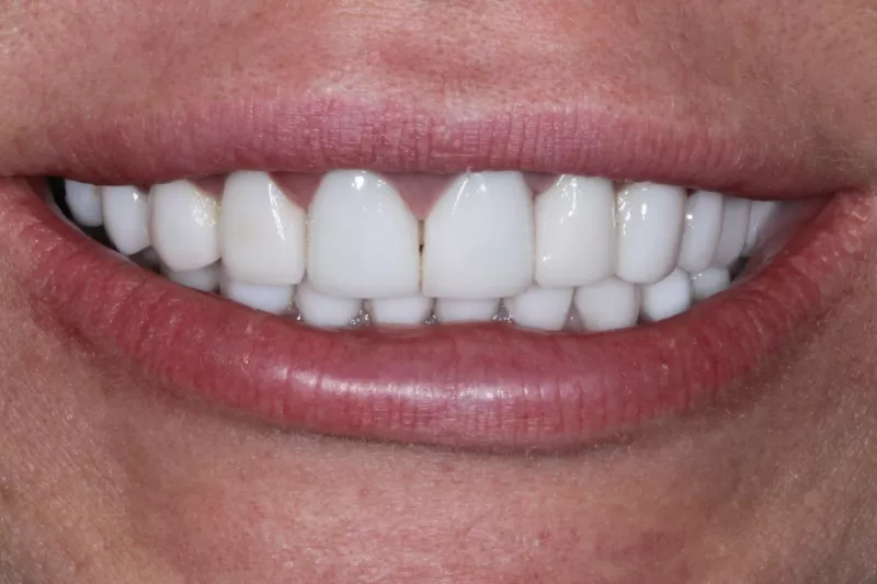 blocky veneers