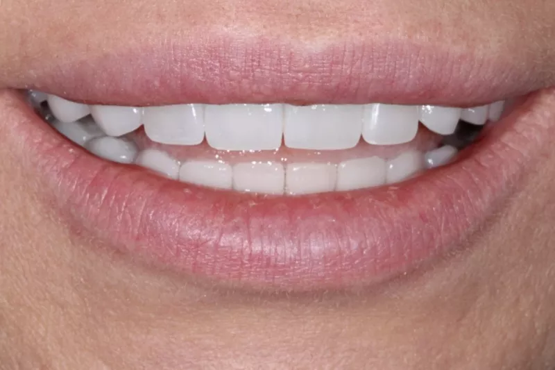 natural, super thin veneers in London