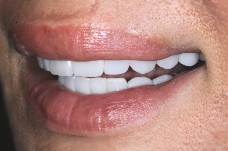 upper and lower non damaging veneers in London by dr aleem