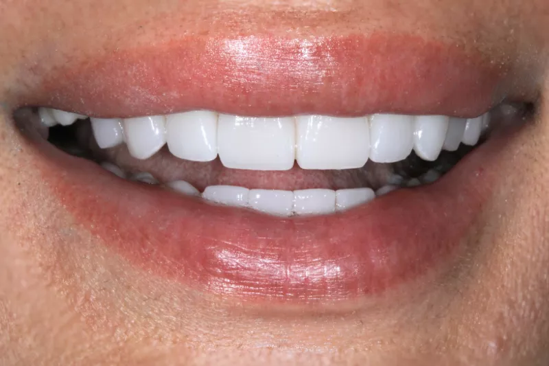 wider smile after no prep veneers by dr aleem