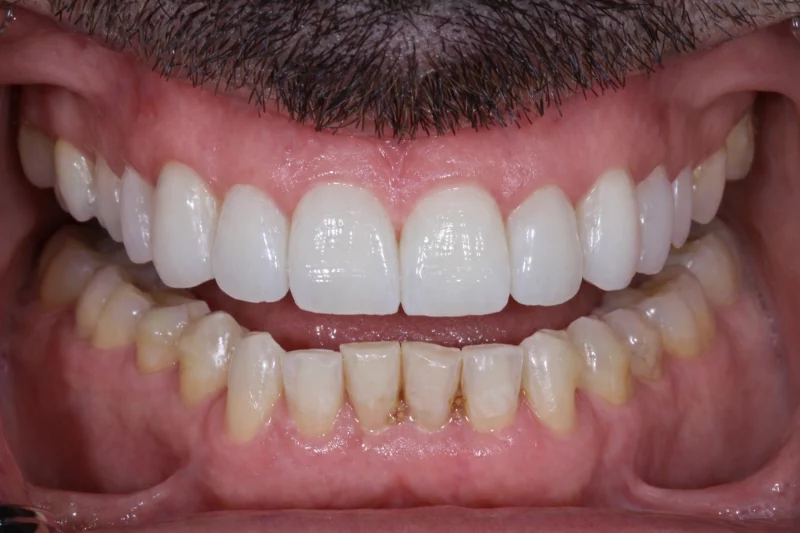 AFTER NON CUTTING VENEERS UPPER ARCH SMILE TRANSFORMATION