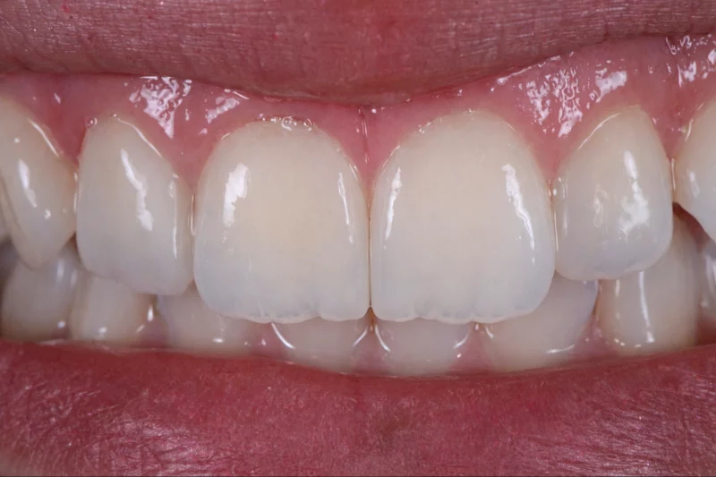 After porcelain veneers by dr aleem handmade wafer thin natural looking results