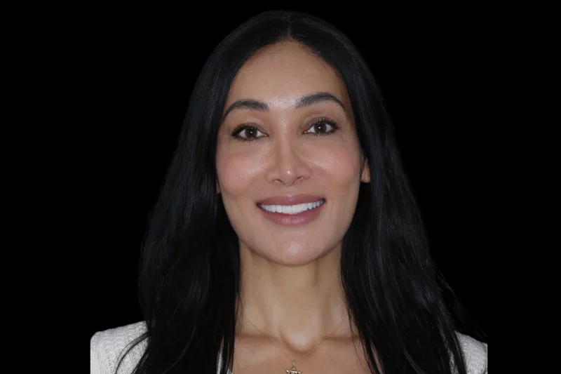 After non cutting veneers full mouth smile makeover by dr aleem