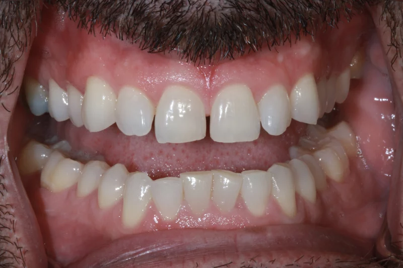 before veneers natural smile