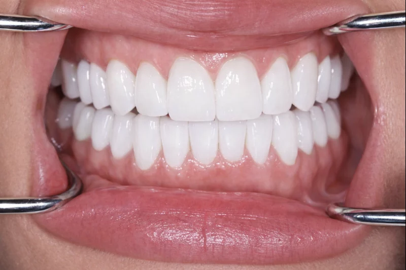 After full mouth smile design with no shave porcelain veneers and crowns by dr aleem