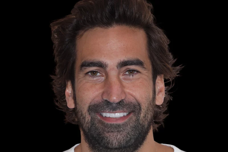 after no prep veneers by dr aleem