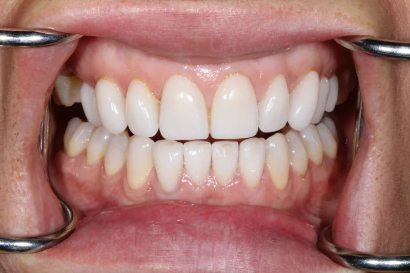 Before full mouth smile makeover in london